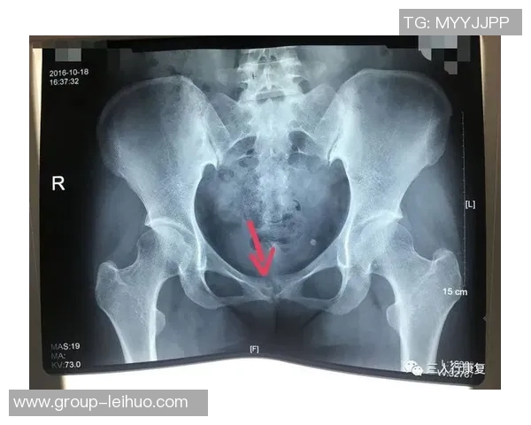 尼科威廉姆斯谈耻骨炎恢复过程并表示需带伤出战的挑战与决心 尼科威廉姆斯谈耻骨炎恢复过程并表示需带伤出战的挑战与决心